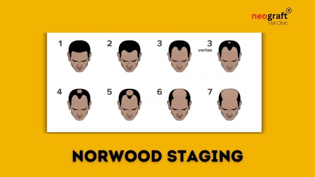 norwood staging male pattern baldness 