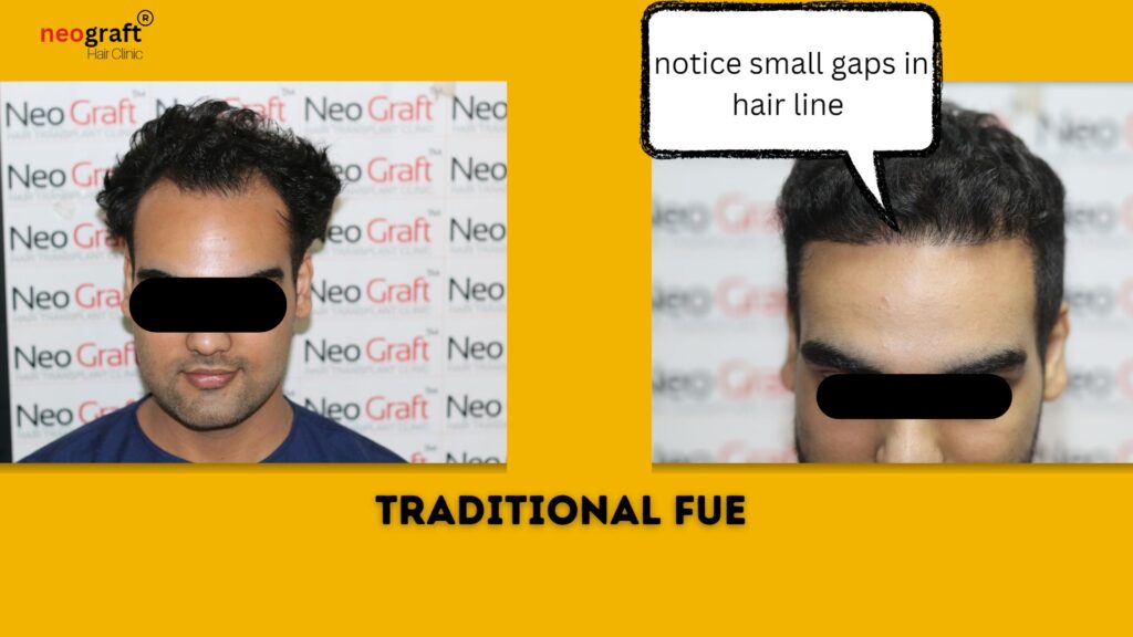 traditional fue-neograft hair clinic