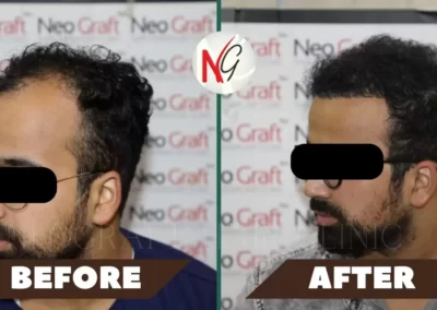 Before After Hair Transplant