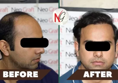 Before After Hair Transplant