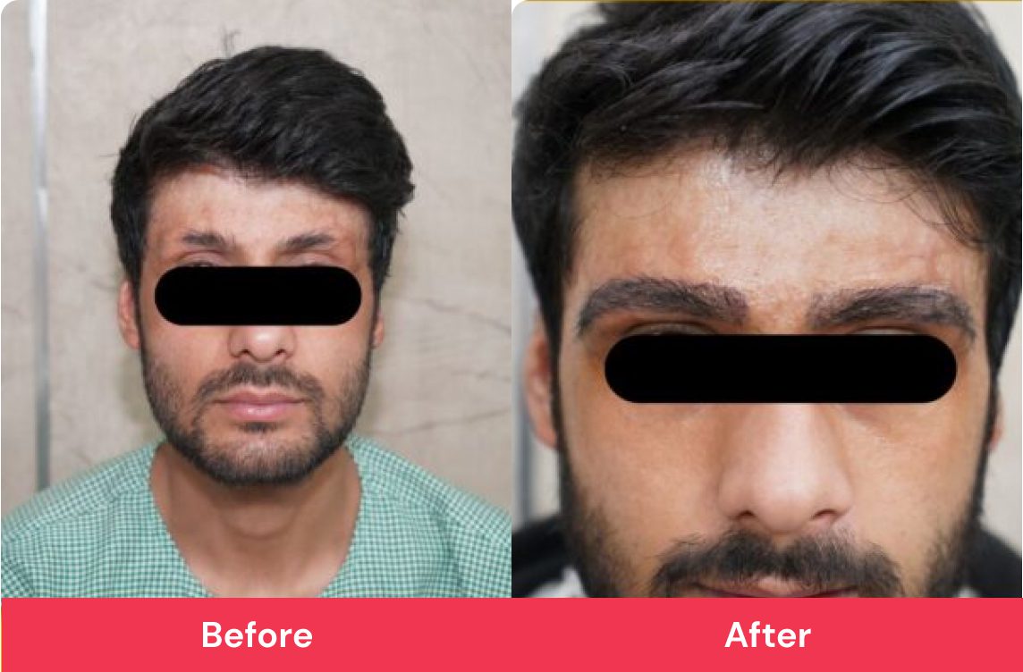 Before and after transplant