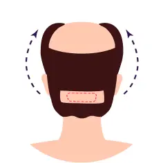 FUT (Follicular Unit Transplant)
