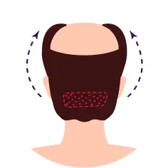 FUE (Follicular Unit Extraction)
