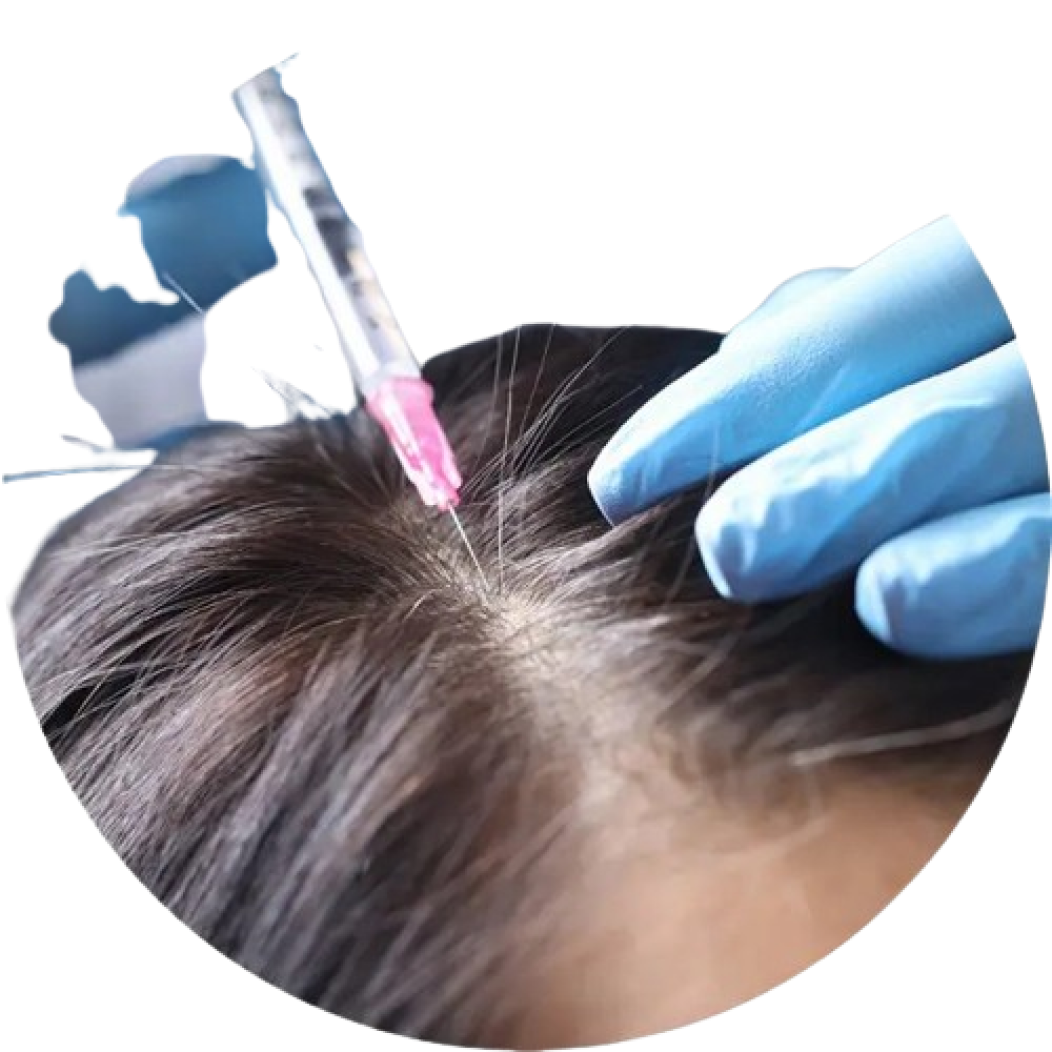GFC treatment for hairs NeoGraft India