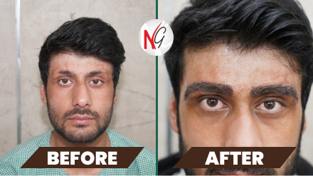 eyebrow-hair-transplant-before-after-1