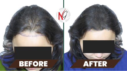 female-hair-transplant-before-after-1