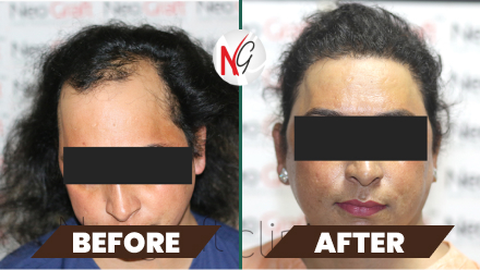 female-hair-transplant-before-after-2