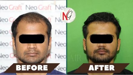 male-hair-transplant-before-after-2
