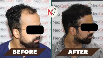 male-hair-transplant-before-after-3