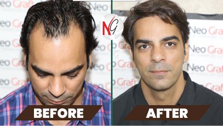 male-hair-transplant-before-after-6