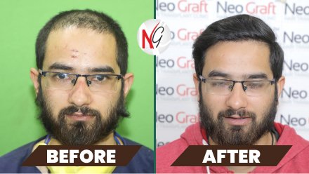 male-hair-transplant-before-after-8