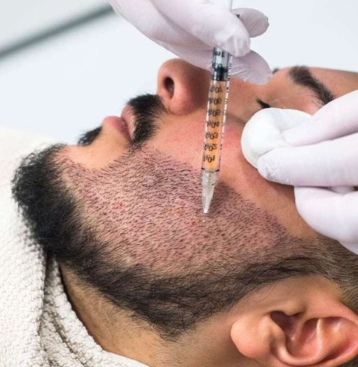 Beard-Transplant in Chandigarh Beard-Transplant in Chandigarh