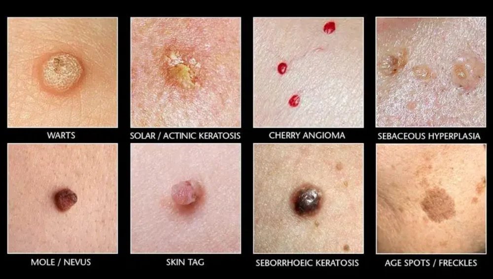 mole wart removal at chandigarh