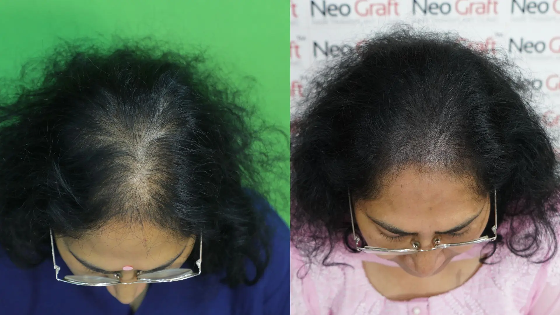 Scalp Micropigmentation