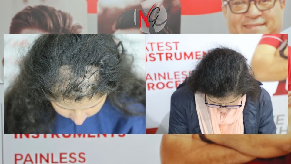 female hair transplant neograft chandigarh<br />
