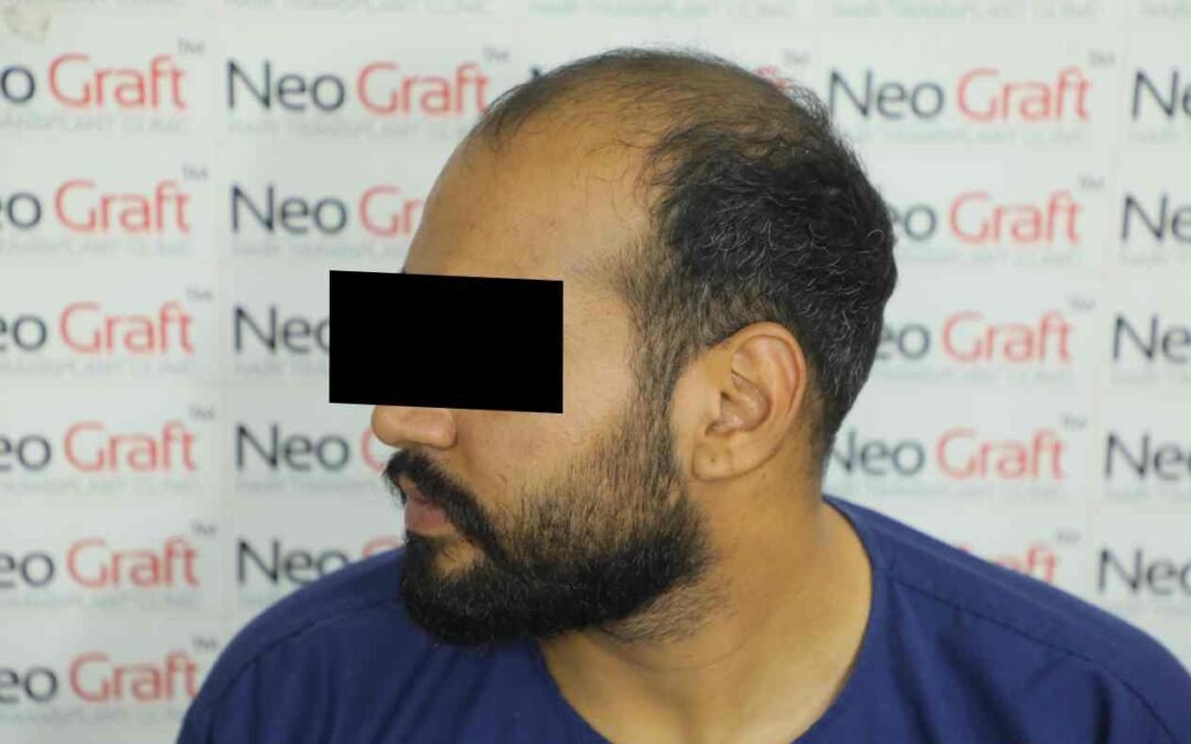 neograft hair clinic results