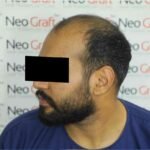 neograft hair clinic results