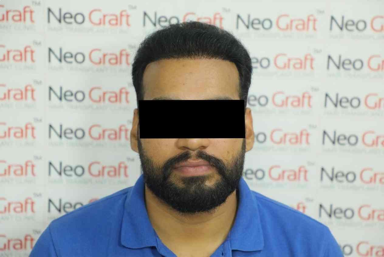 Hair transplant result - NeoGraft India