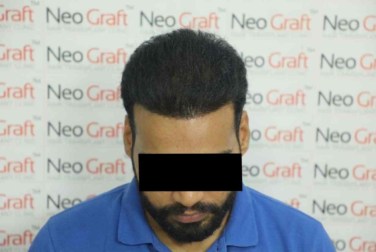 Hair transplant result - NeoGraft India