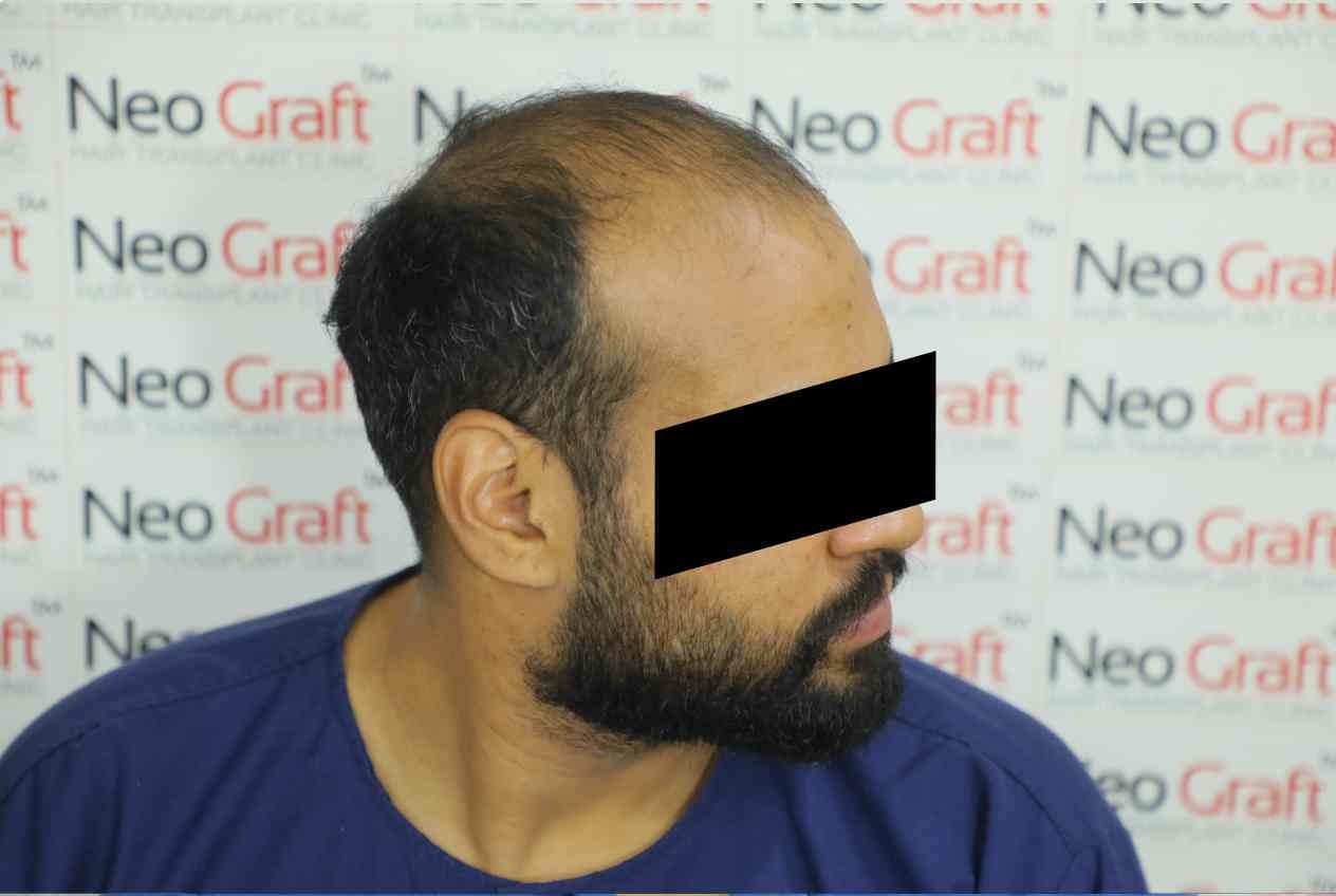 Hair transplant result - NeoGraft India