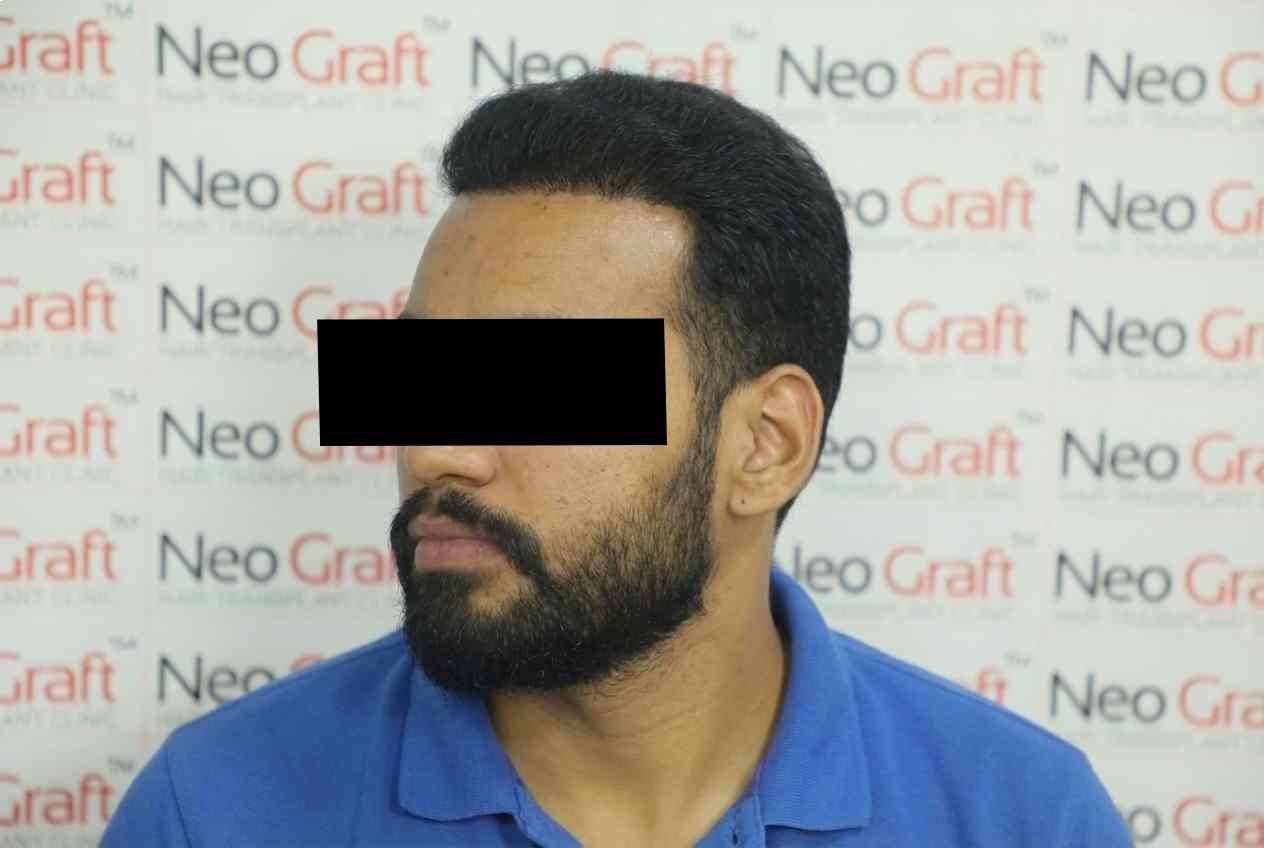 Hair transplant result - NeoGraft India