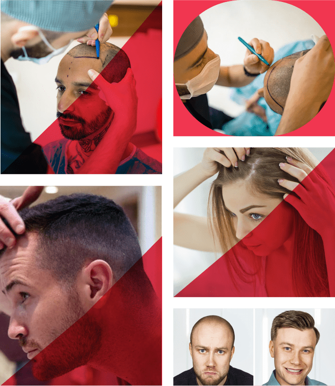 Frame 1032736 - NeoGraft Hair Clinic Chandigarh