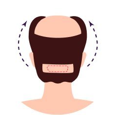 FUT (Follicular Unit Transplant)