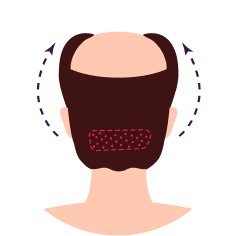 FUE (Follicular Unit Extraction)