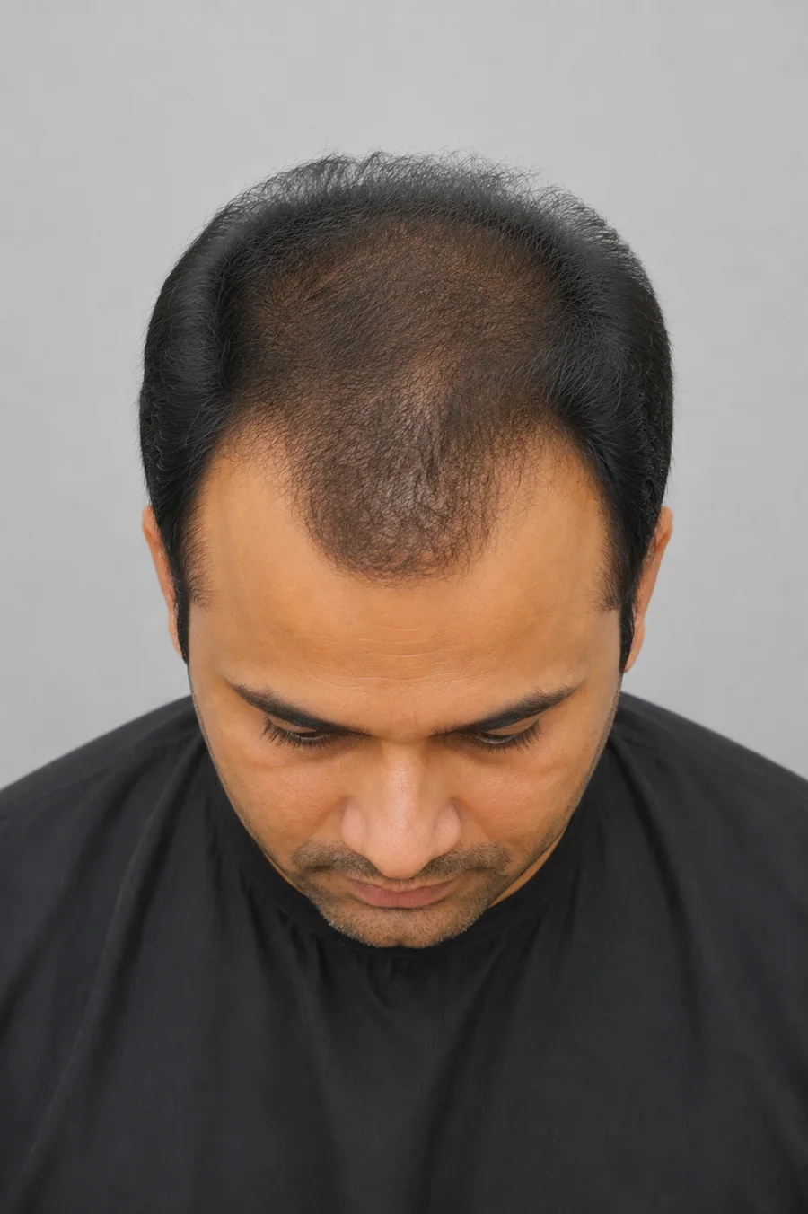Reference top and crown photo angle