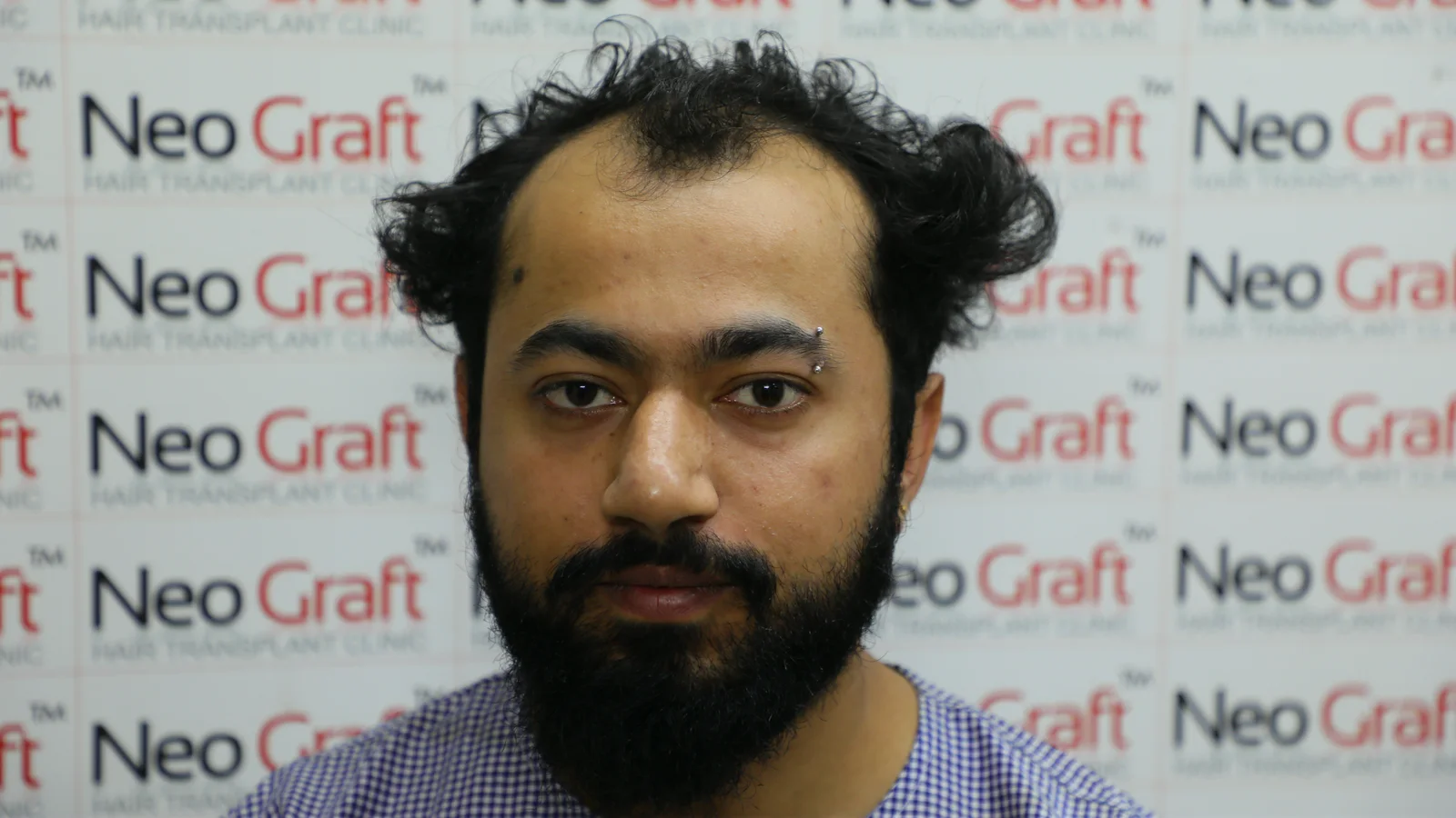 Hair restoration journey – before and result views — Before