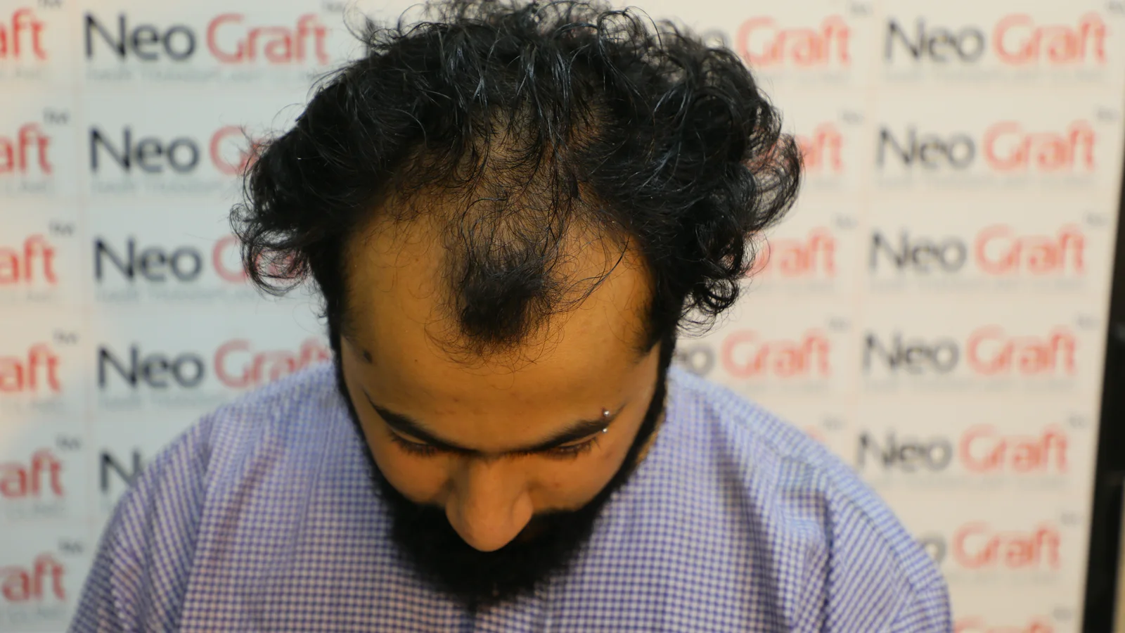 Hair restoration journey – before and result views — result angle 1