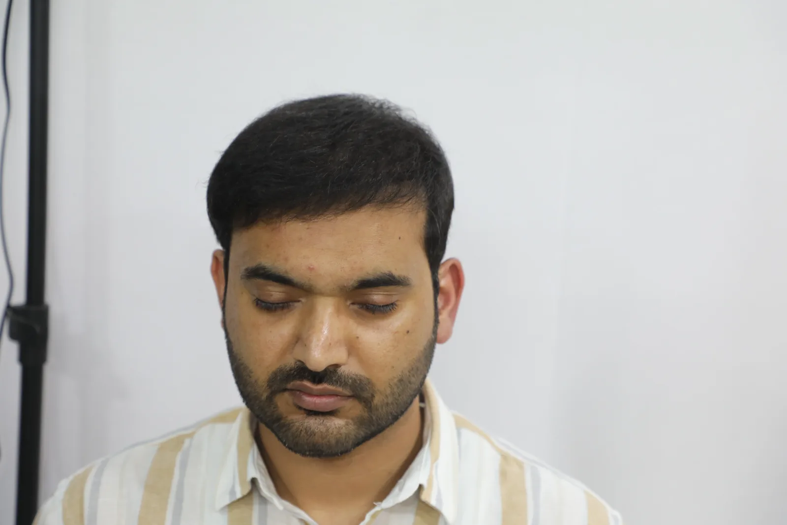 Complete hair restoration journey – frontal, top and rear views — result angle 1