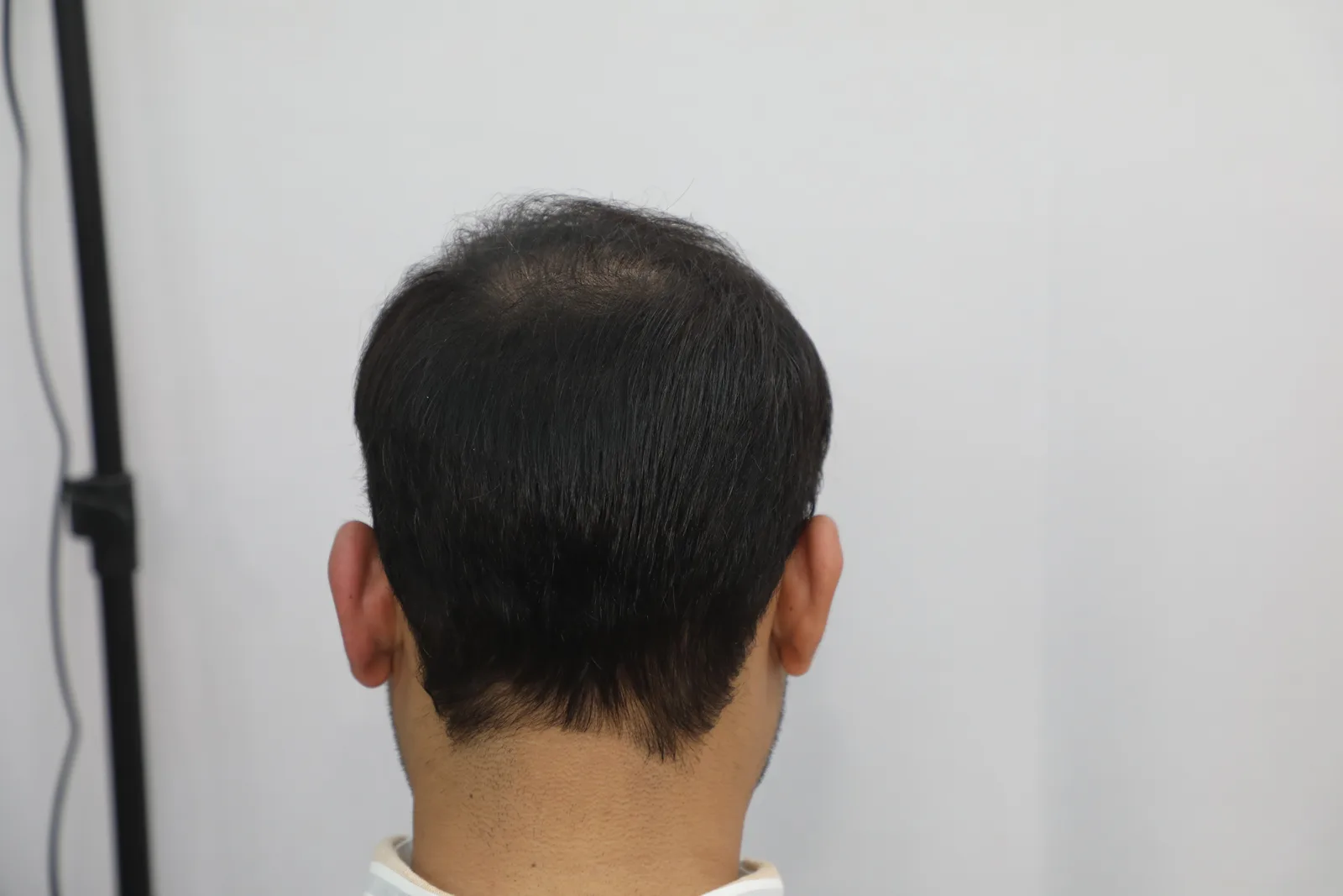 Complete hair restoration journey – frontal, top and rear views — result angle 2