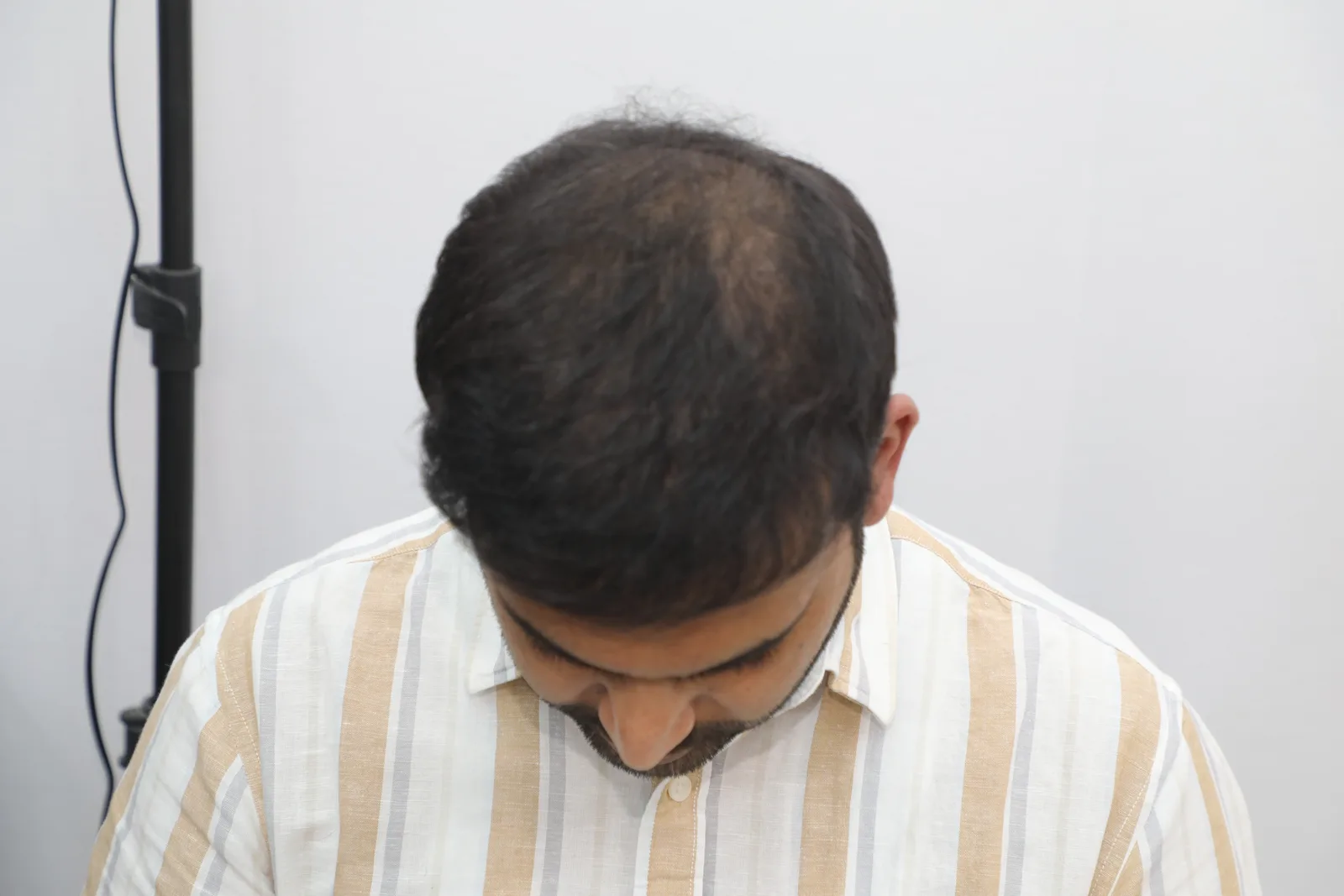 Complete hair restoration journey – frontal, top and rear views — After