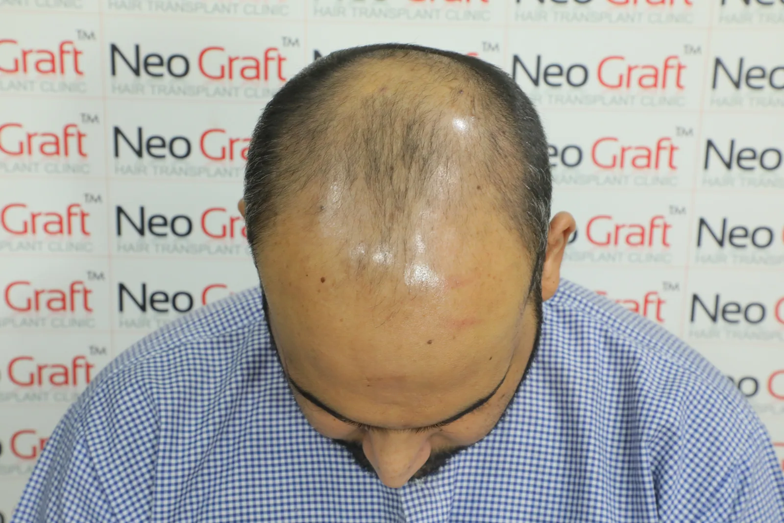 Complete hair restoration journey – frontal, top and rear views — Before