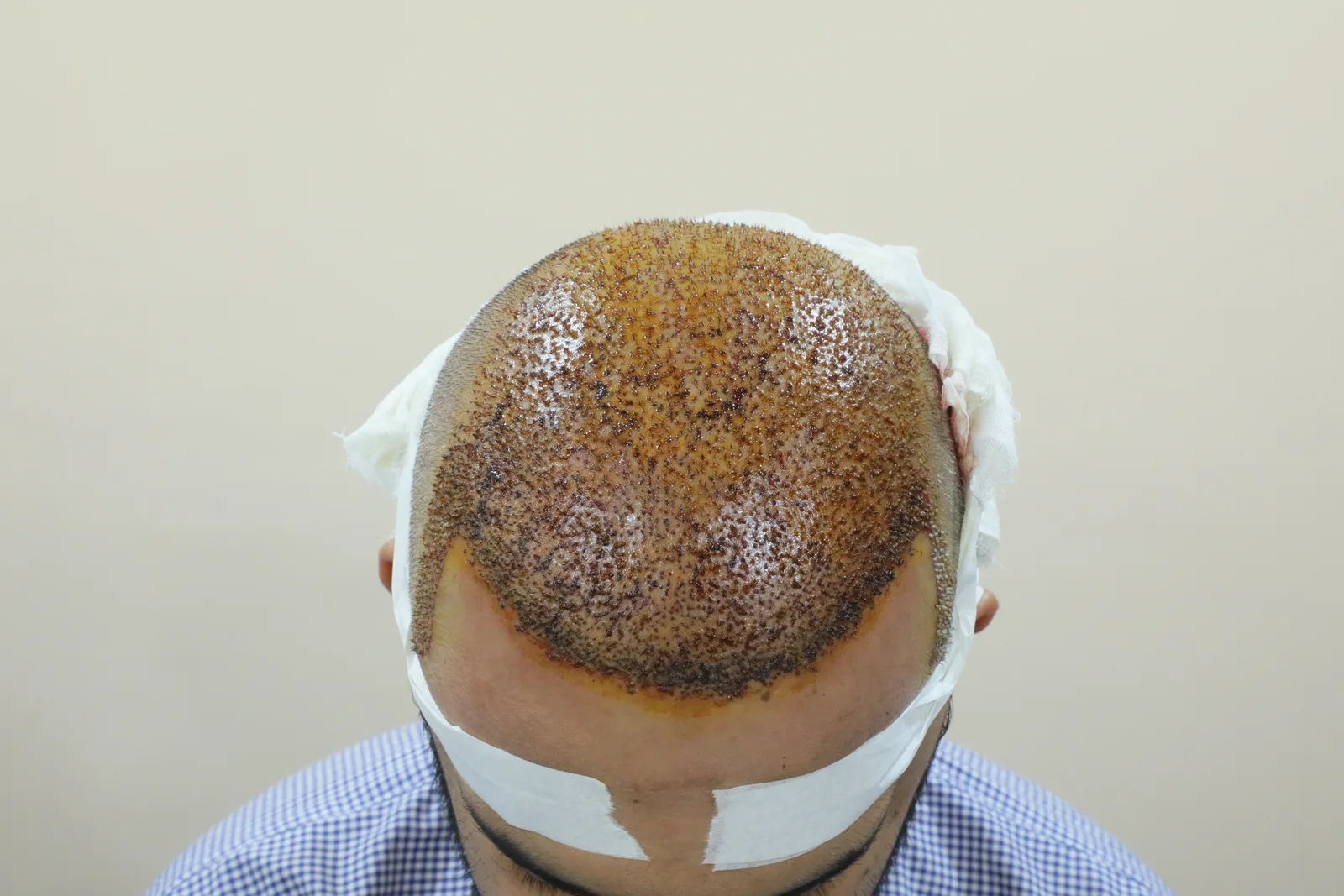 Complete hair restoration journey – frontal, top and rear views — Procedure Day