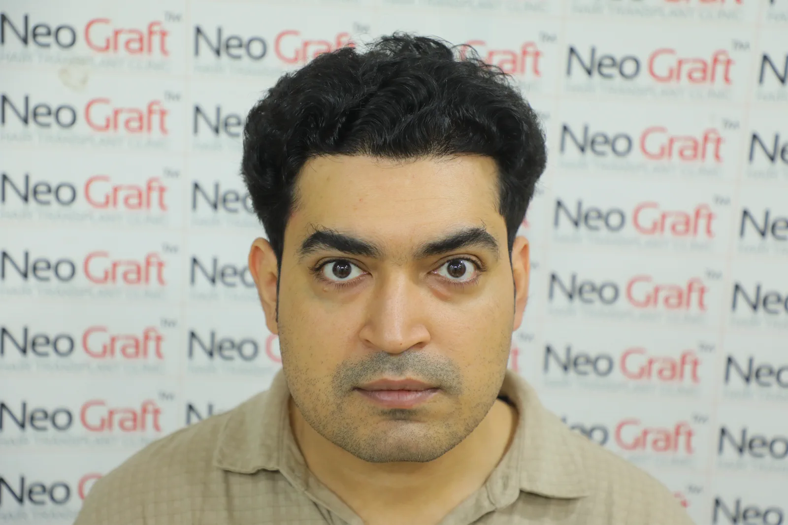 2500-graft NeoDHT® client story — result angle 1