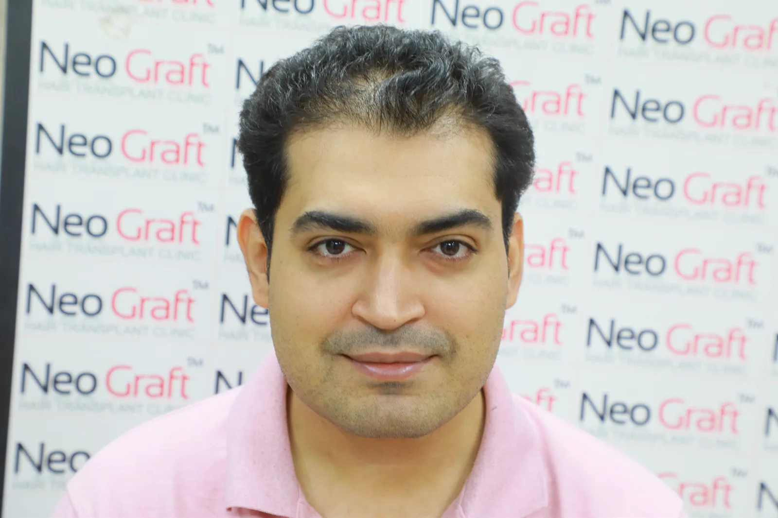 2500-graft NeoDHT® client story — Before