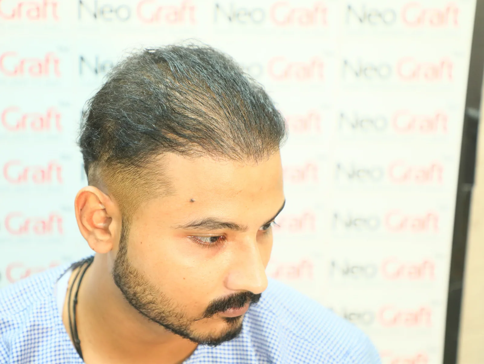 NeoDHT® Hair Restoration Client Story — result angle 4