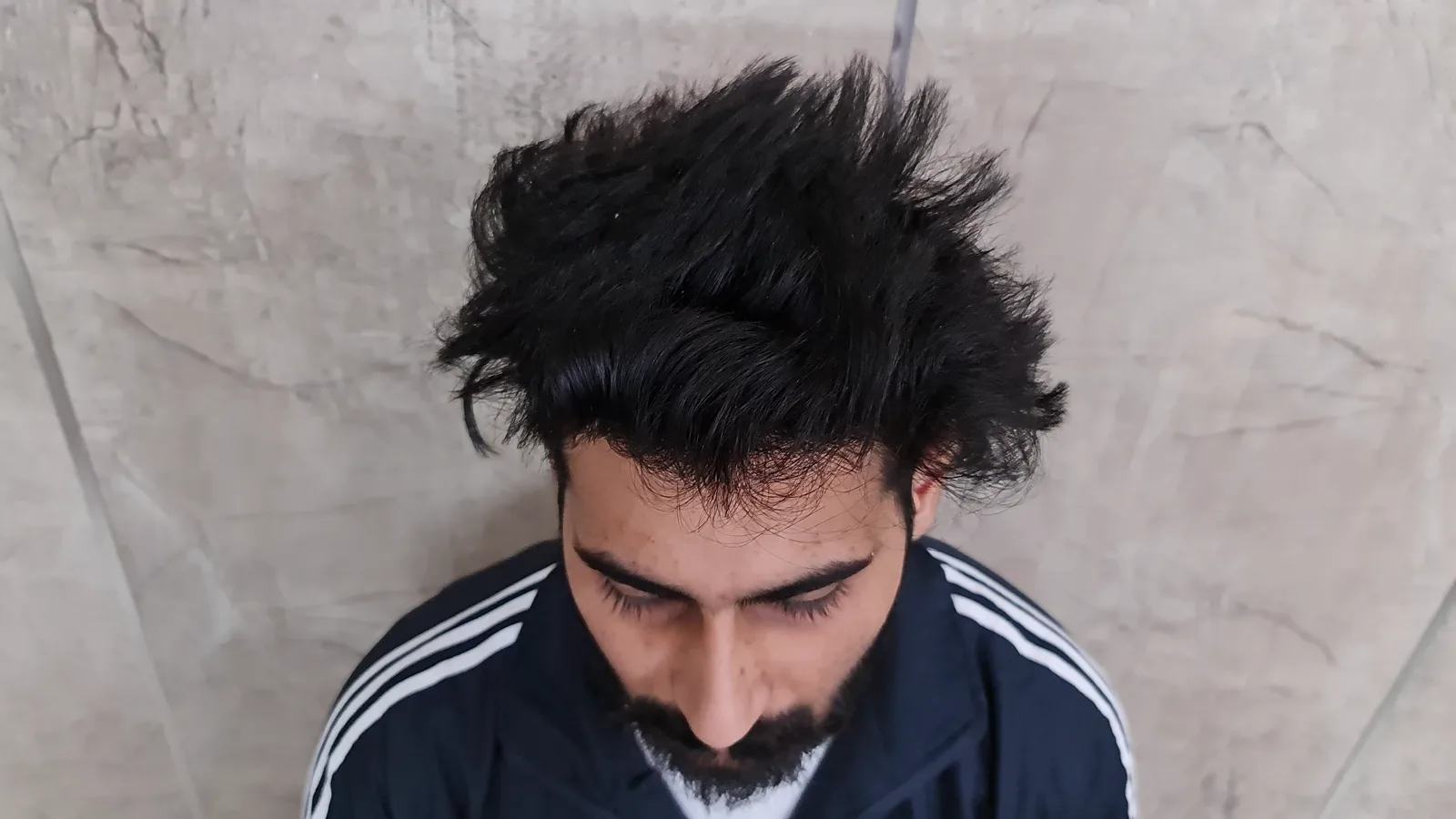 Complete Hairline Restoration Journey — After