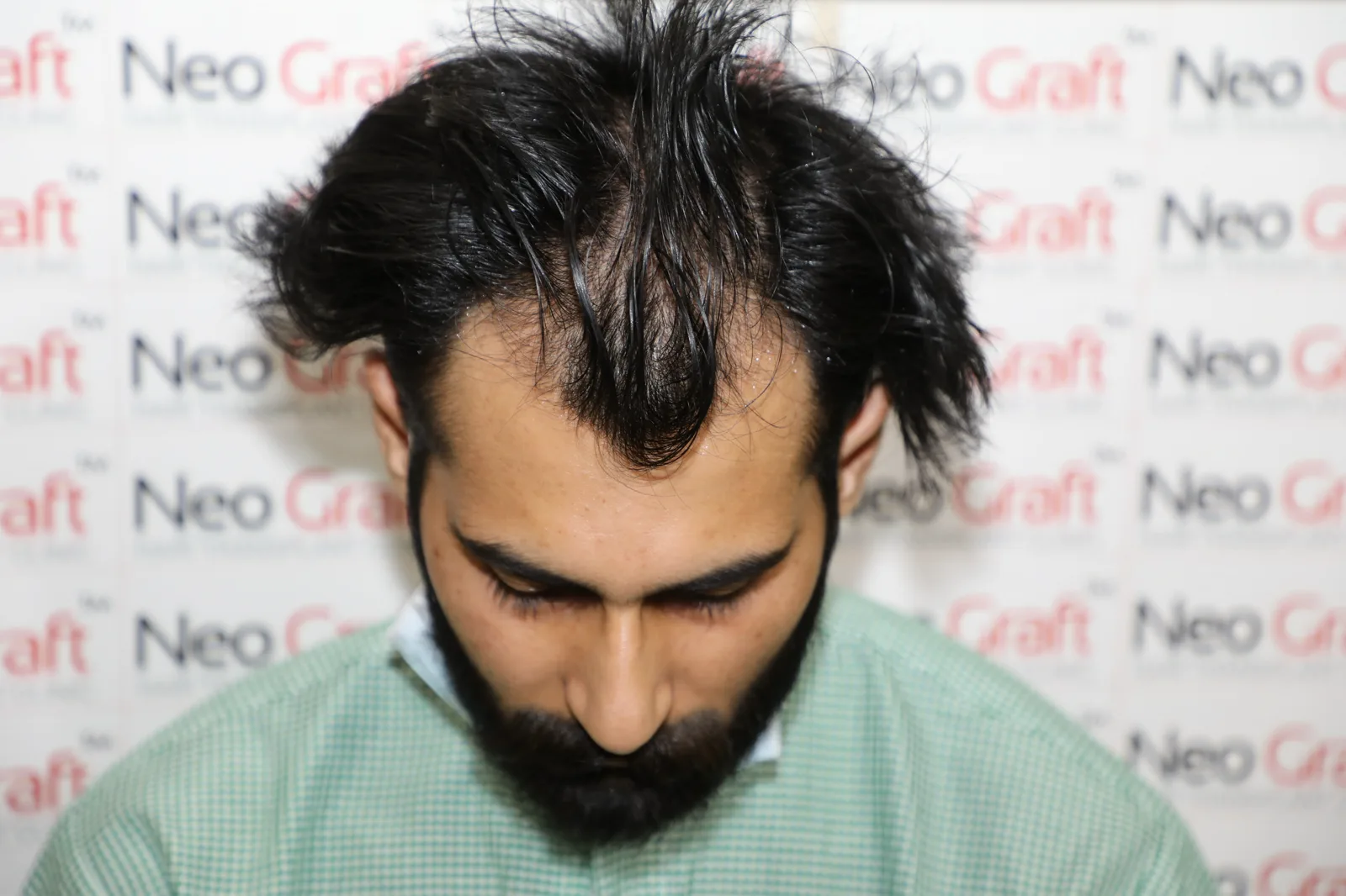 Complete Hairline Restoration Journey — Before