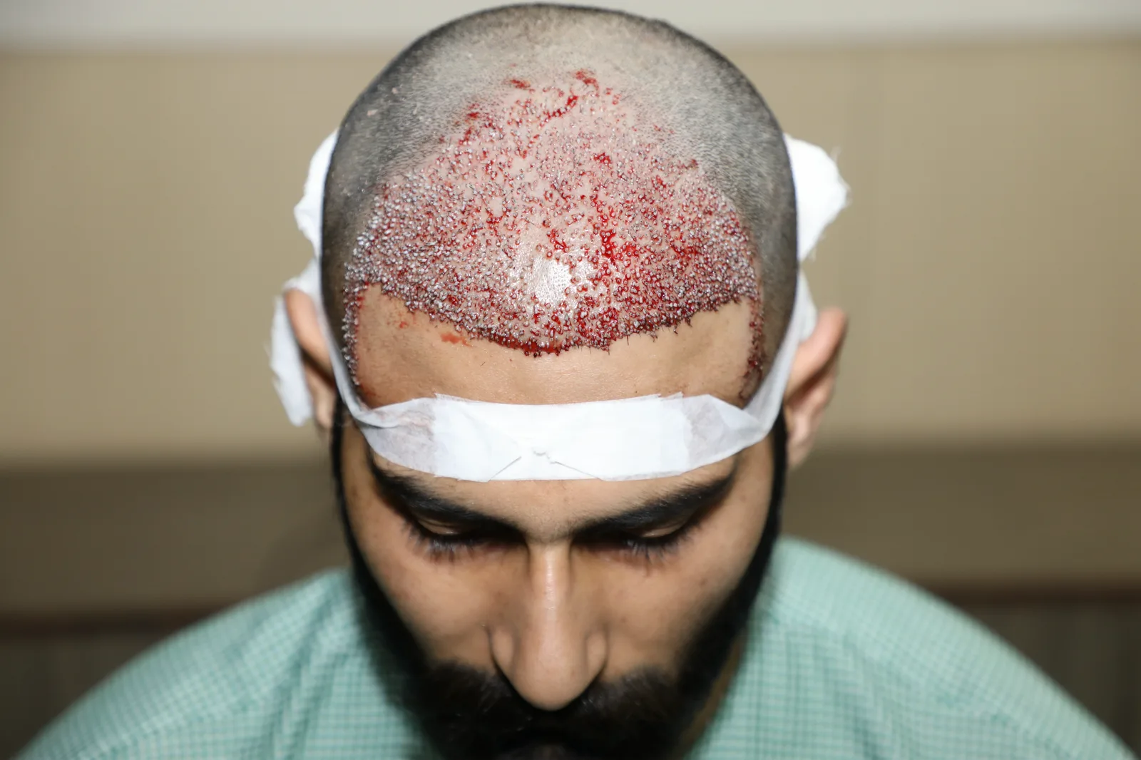 Complete Hairline Restoration Journey — Procedure Day