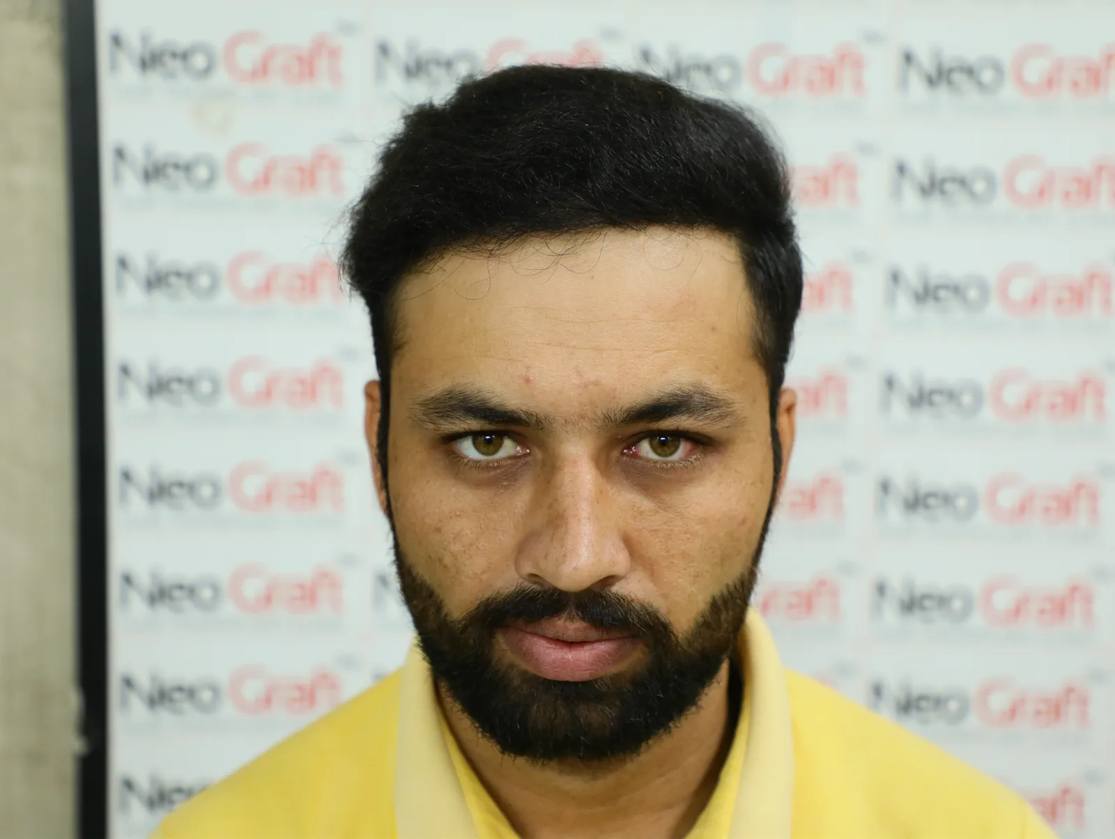 Complete NeoDHT Hair Restoration Journey — After