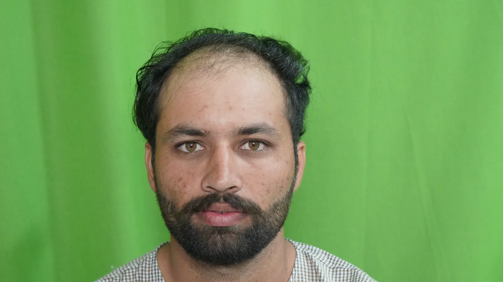 Complete NeoDHT Hair Restoration Journey — Before