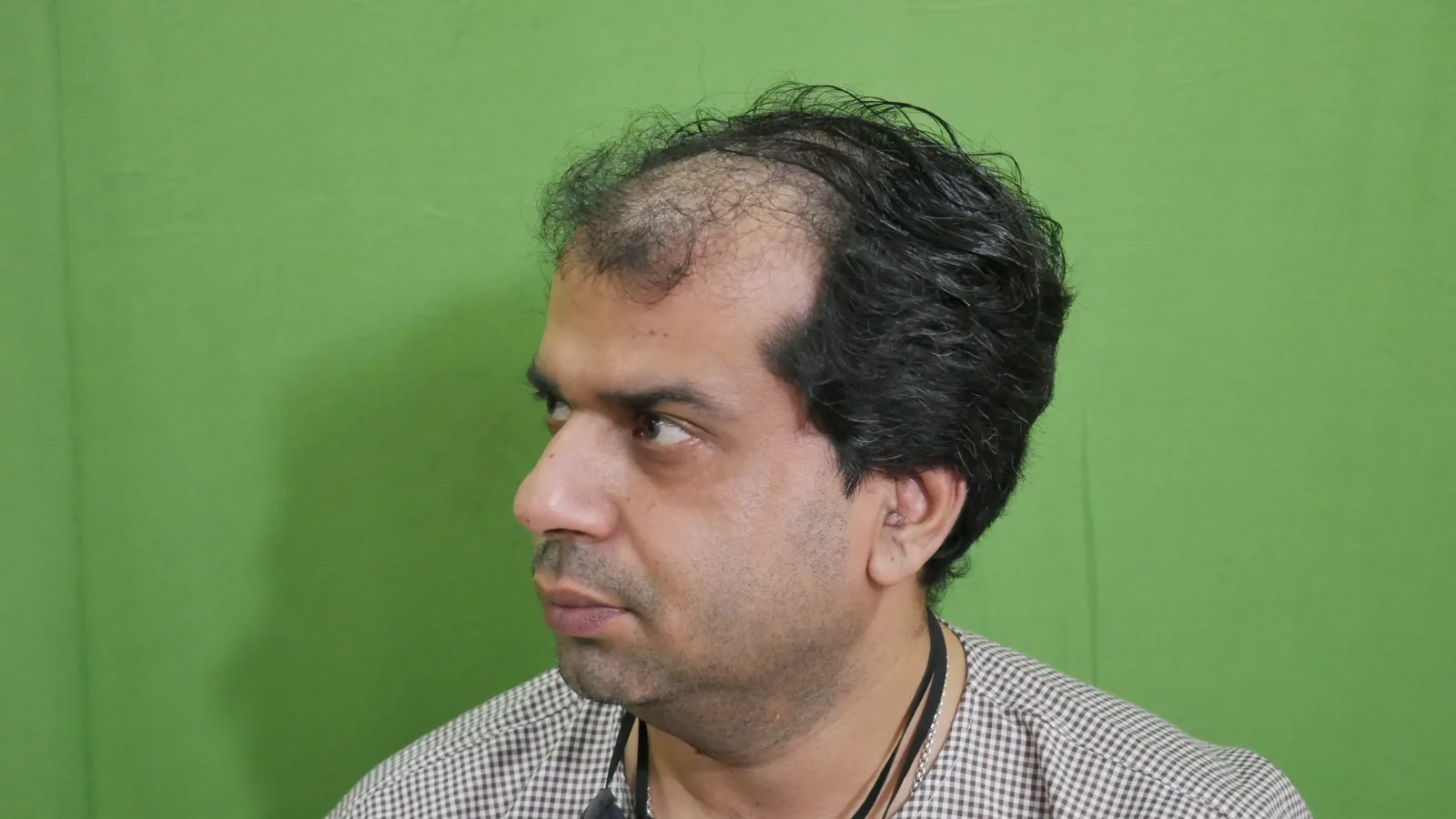Hair restoration journey – frontal and top coverage — Before
