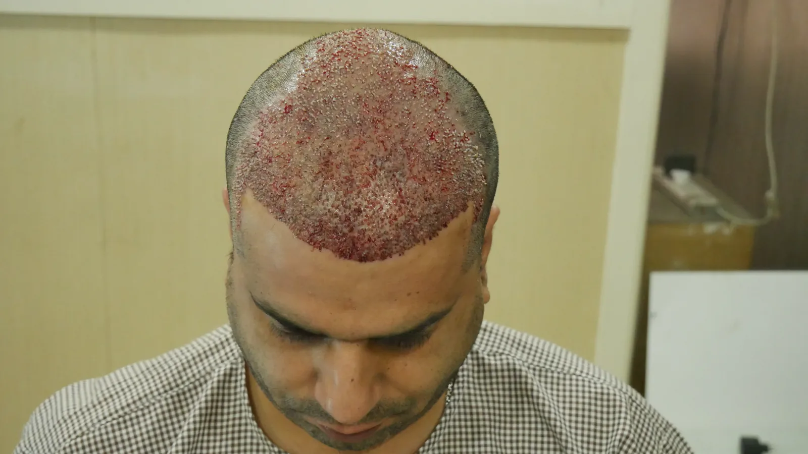Hair restoration journey – frontal and top coverage — Procedure Day