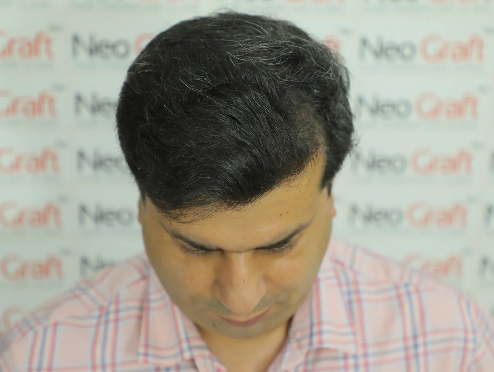 Hair restoration journey – frontal and top coverage — After