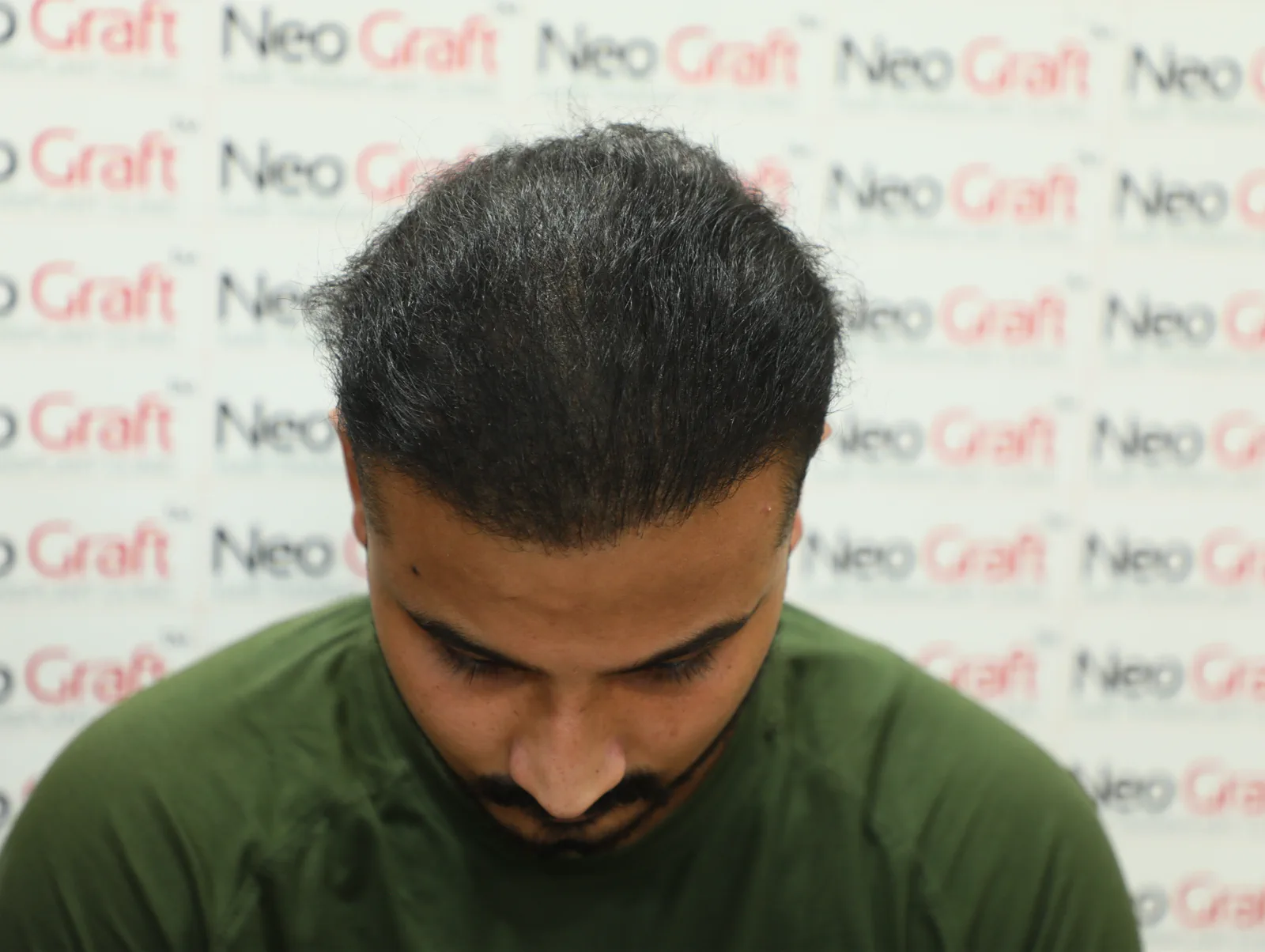 Previous FUE Hair Transplant Improved with Scalp Micropigmentation — result angle 2