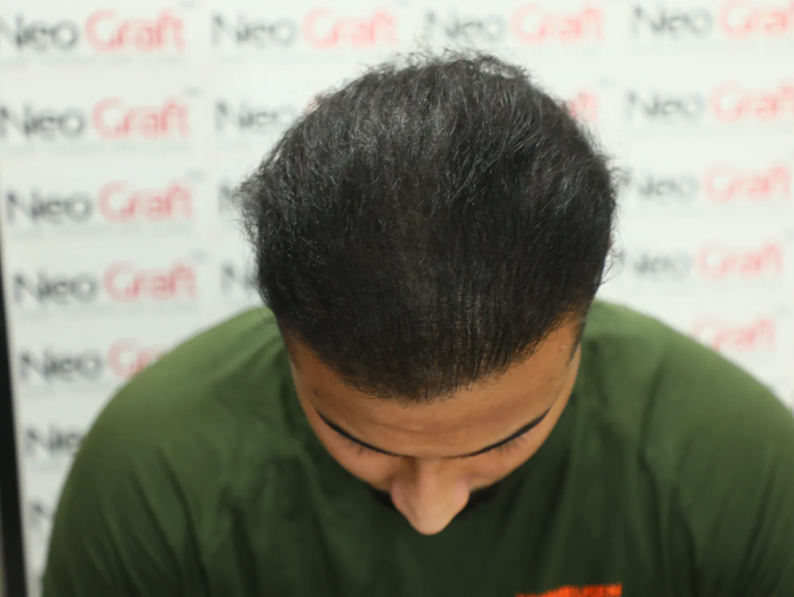 Previous FUE Hair Transplant Improved with Scalp Micropigmentation — After