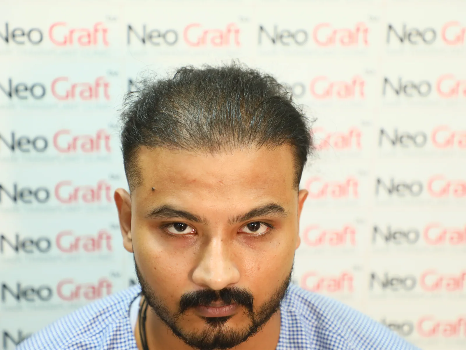 Previous FUE Hair Transplant Improved with Scalp Micropigmentation — result angle 1